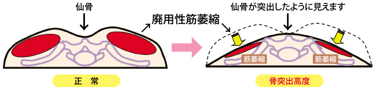 病的骨突出の原因