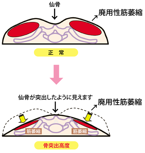 病的骨突出の原因